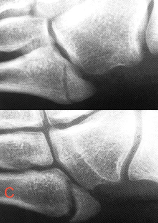 Figure 6 for case Fifth metatarsal base injuries